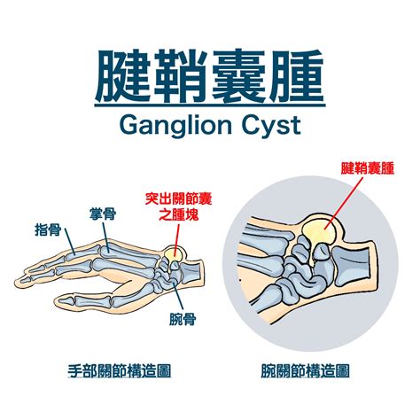 劍鞘腫|腱鞘囊腫 Ganglion Cyst｜手腕疾病專欄｜手外科醫